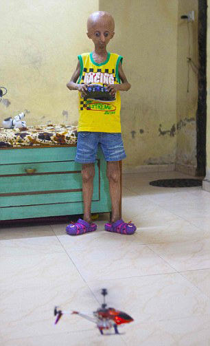 比策(nihal bitla)患上早衰症,体重仅为12.5公斤,身高仅1.2米.