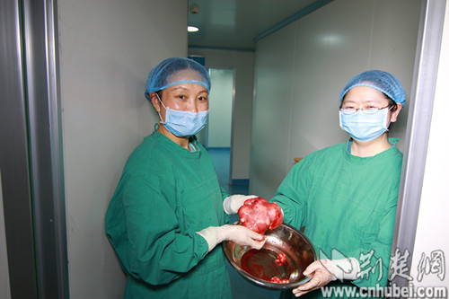 49岁妇女腹胀如孕妇 医院为其摘除5斤重子宫肌瘤